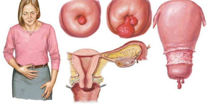 bệnh polyp cổ tử cung là gì 2