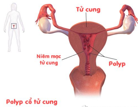 chi phí chữa bệnh polyp cổ tử cung 1
