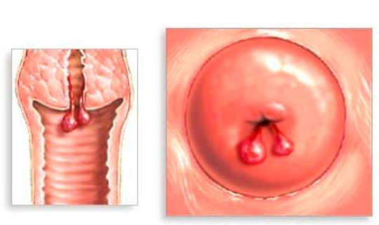 dấu hiệu bệnh polyp cổ tử cung 1