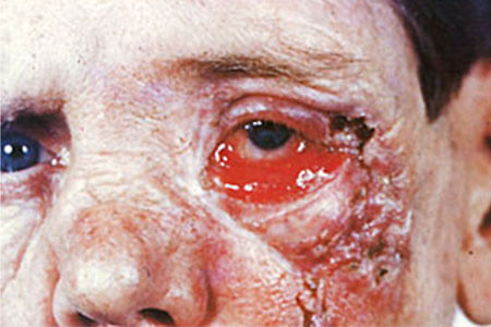 Hình ảnh bệnh giang mai giai đoạn cuối ở mắt