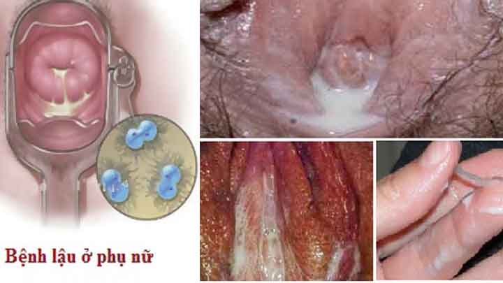 Hình ảnh bệnh lậu ở bộ phận sinh dục nữ