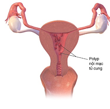phương pháp chữa bệnh polyp cổ tử cung 1