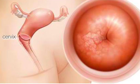  polyp cổ tử cung có ảnh hưởng tới khả năng mang thai 1