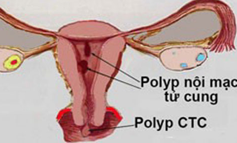 tác hại của bệnh polyp cổ tử cung 1