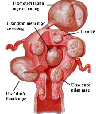 u xơ tử cung có thể mang thai không 1