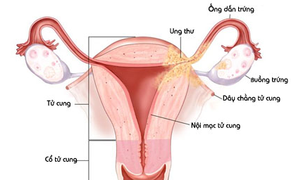 viêm nội mạc tử cung là gì 1
